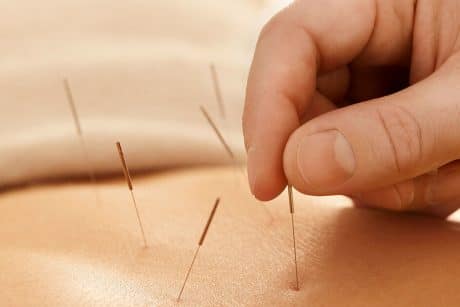leczenie bólu za pomocą akupunktury
