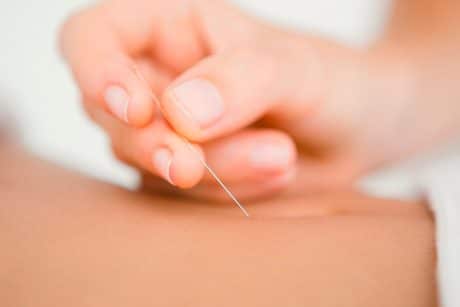 Akupunktura brzucha