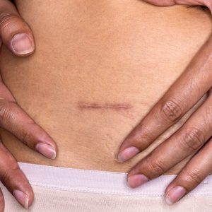 Zintegrowana terapia blizn ITCM DAO