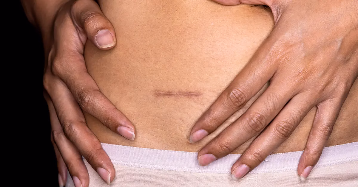 Zintegrowana terapia blizn ITCM DAO