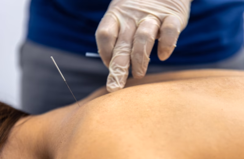 Akupunktura w stwardnieniu rozsianym ITCM DAO